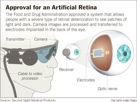 Graphic depiction of how the Argus Retinal Prosthesis System (Argus II) "bionic" eye works