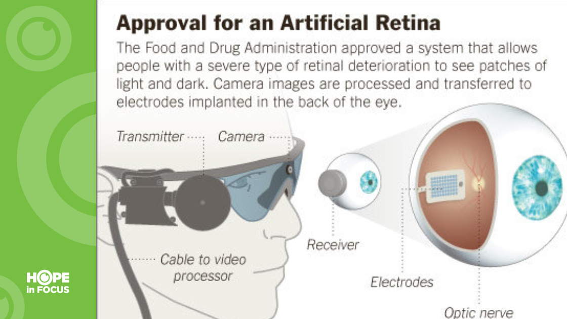 Approval for an Artificial Retina graphic